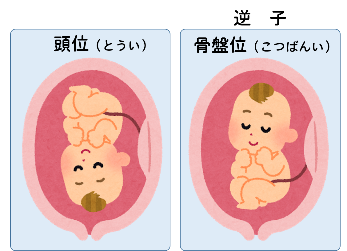 逆子の原因と対策